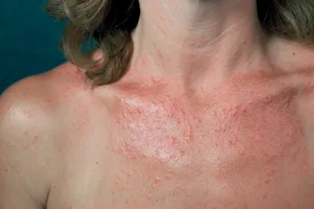 Fotodermatitis