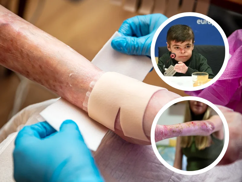 pie-de-un-paciente-con-vendajes-por-enfermedad-piel-de-mariposa