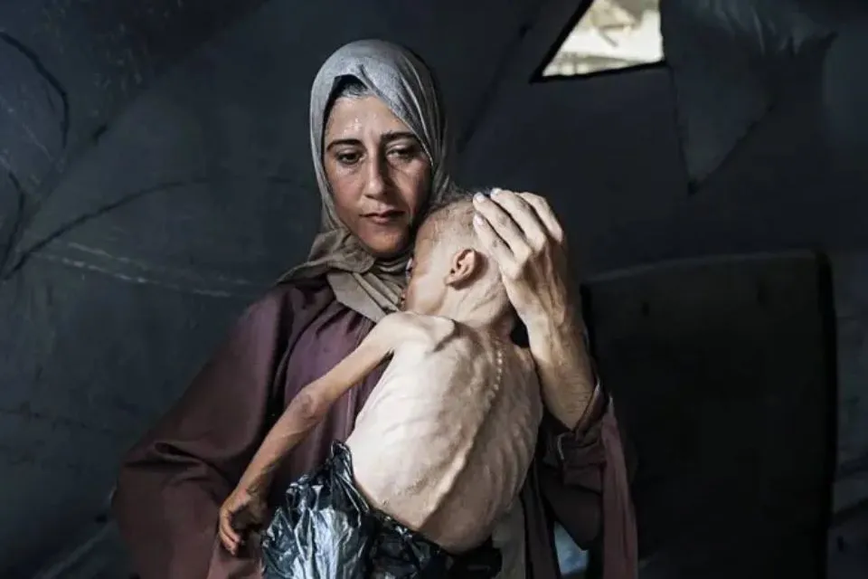 Un niño de un año y medio que padece desnutrición aguda debido al bloqueo israelí en Gaza|Foto: BBC Mundo/Getty Images