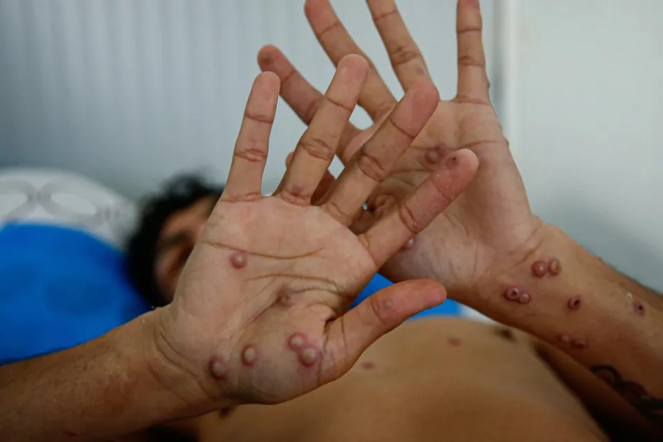 Viruela del mono / Europa Press