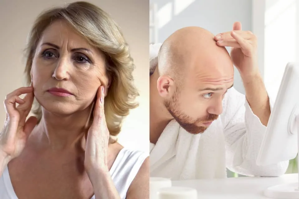 Envejecimiento - calvicie 