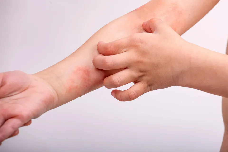 Dermatitis en los meses cálidos