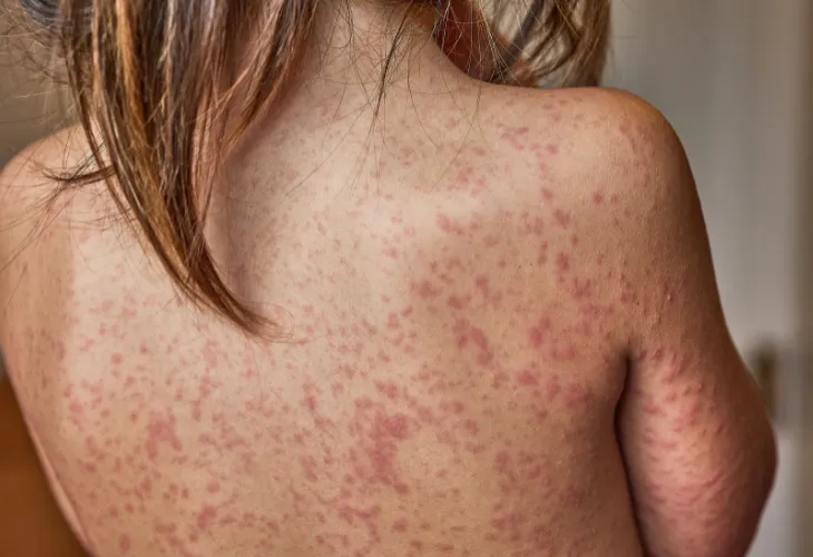 Fotodermatitis  Fotodermatitis