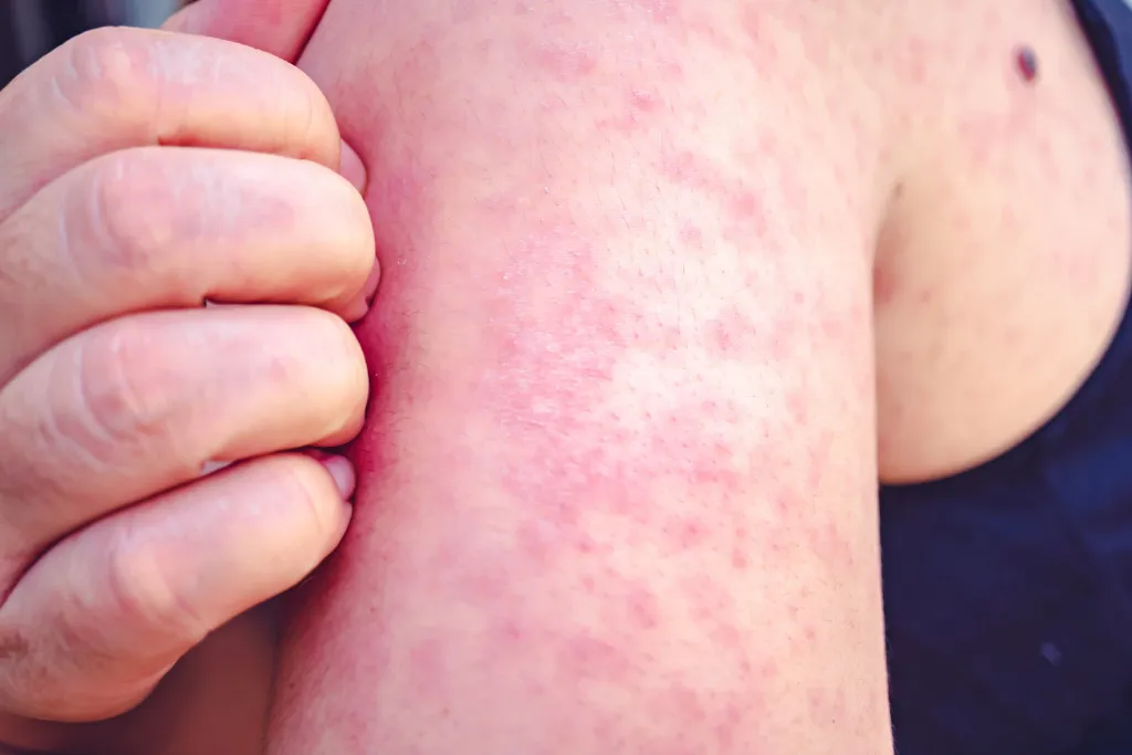 Enfermedad Sarampión 