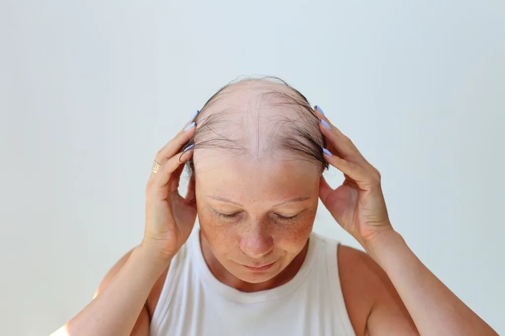 alopecia-en-mujeres-1